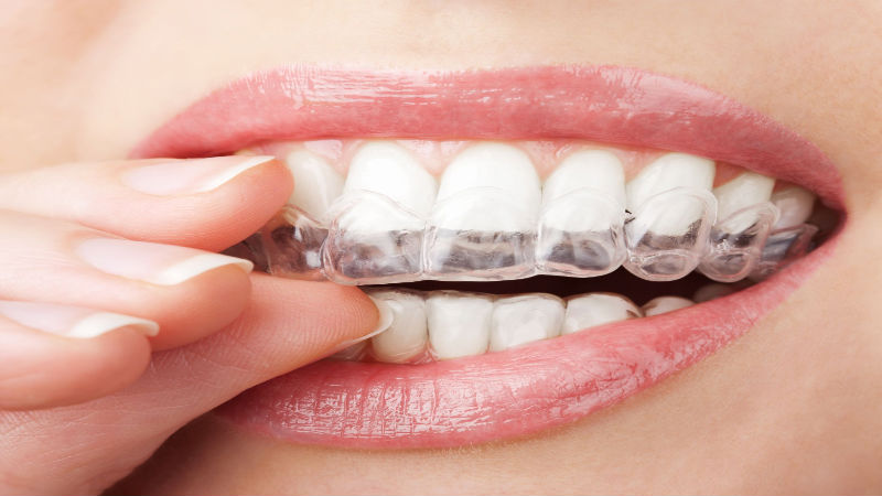 Invisalign Straightens Teeth Without Any of the Embarrassment of Metal Braces