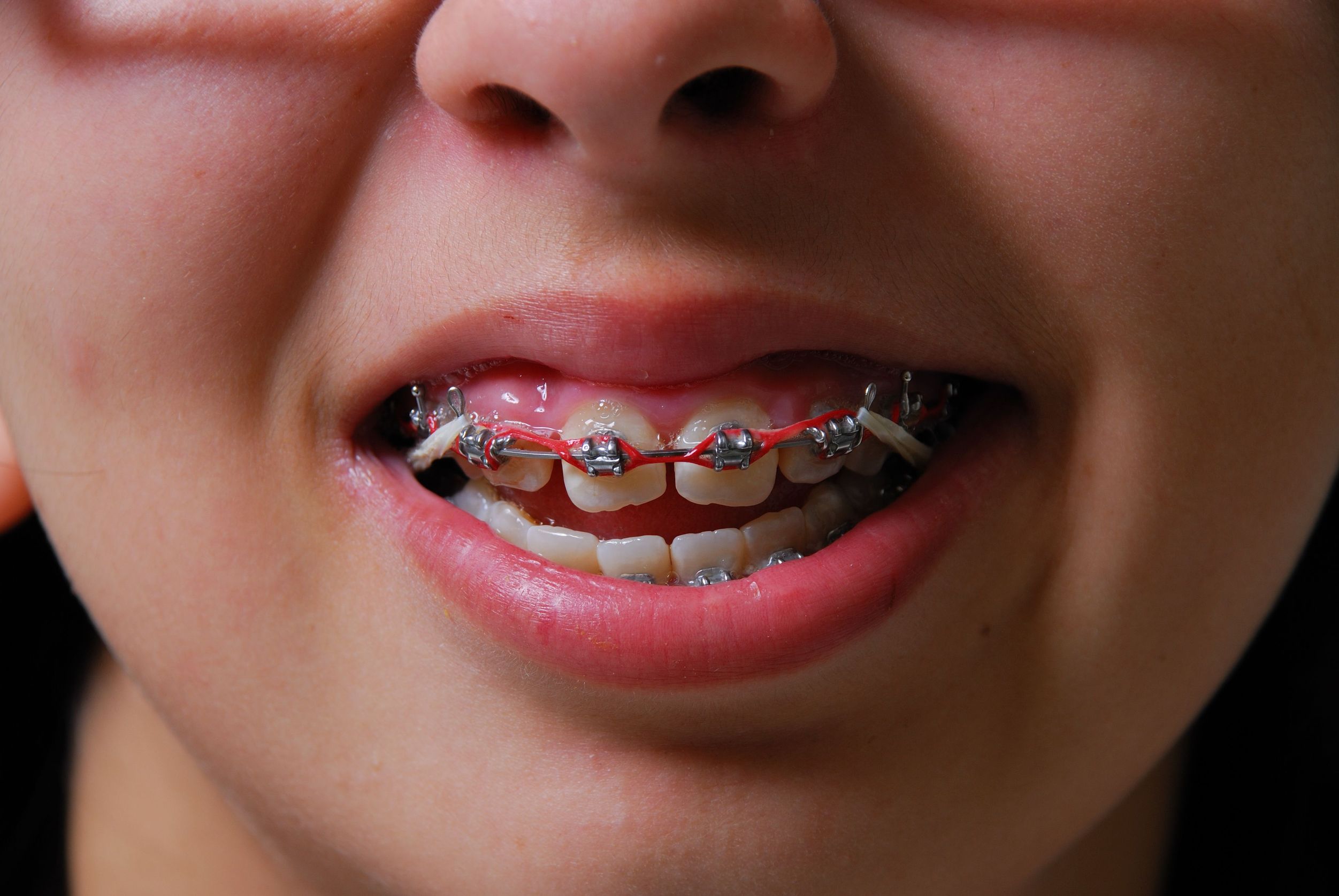 Do You Think You May Be A Candidate For Braces?