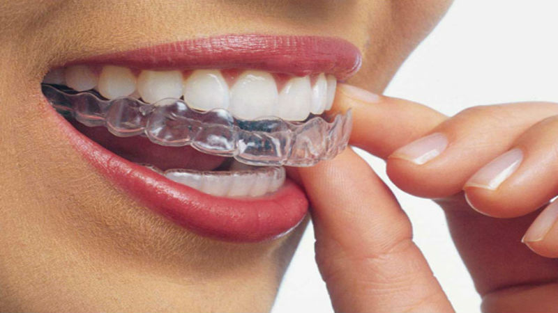 Are You Considering a Dental Implant?