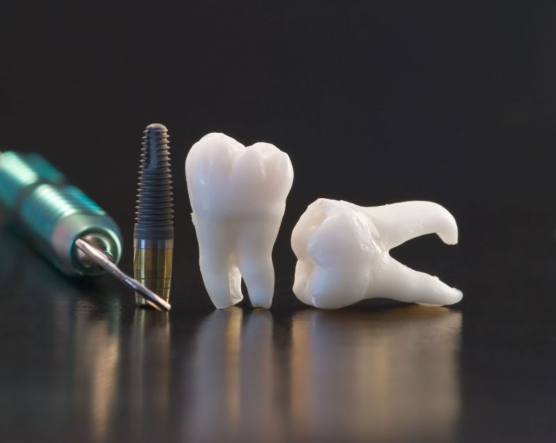 Are Implants in Short Hills NJ The Correct Solution?