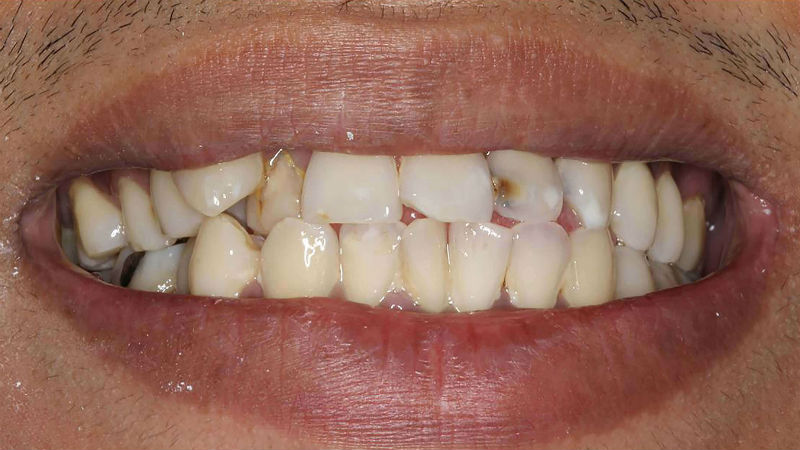 Two Important Questions Answered About Porcelain Veneers In Midwest City OK