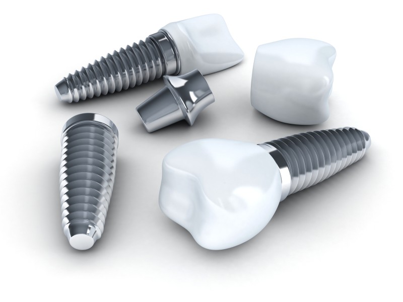 A Lasting Solution: The Benefits of Dental Implants in Willmar
