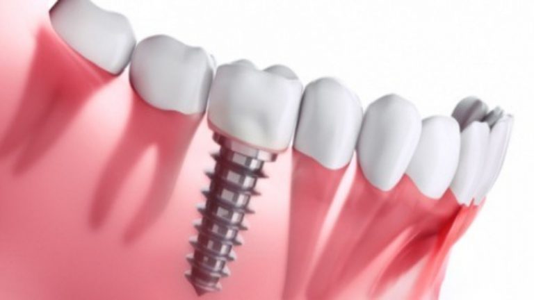 Improving Your Smile with the Use of Cosmetic Dentistry in Upatoi, GA