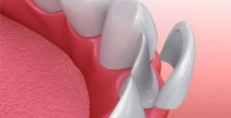Exciting Information on Dental Implants in Pine Mountain, GA