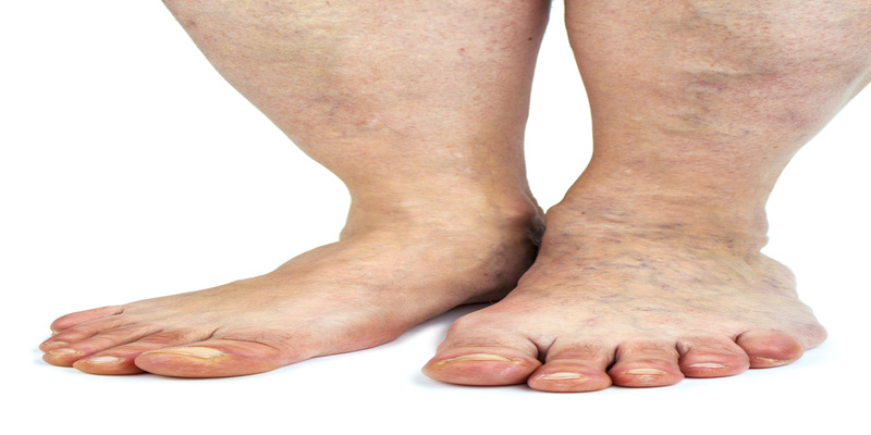 Signs You Should Visit a Vein Clinic in Tucson