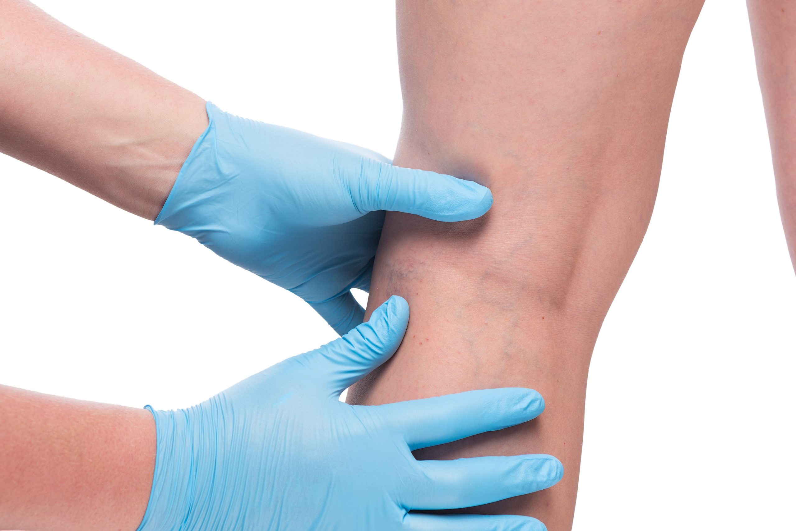 The Vein Benefits at a Center for Vein Restoration in Hamilton, NJ