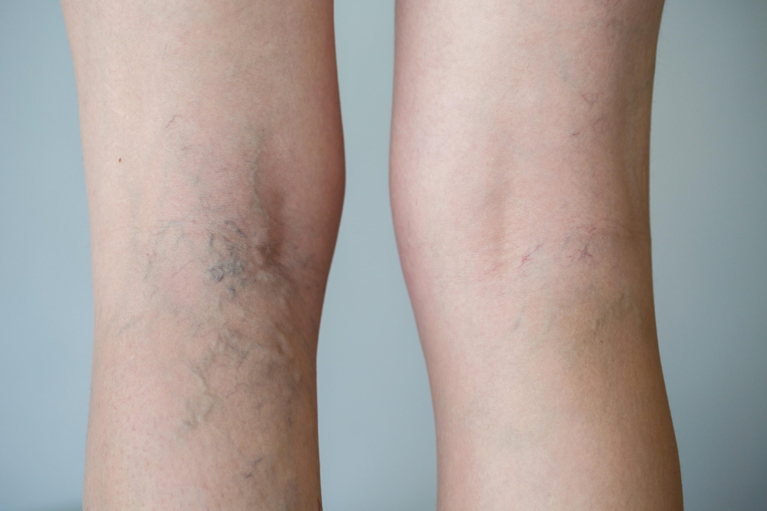 4 Reasons to Consult a Vein Doctor Near Pennsylvania for Varicose Veins in Pregnancy