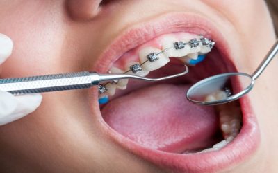 Choosing the Best Orthodontist Fort Lauderdale, FL for a Healthy, Confident Smile