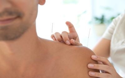 Find Relief With Acupuncture For Stress, Bellingham, WA Residents Can Rely On Every Day