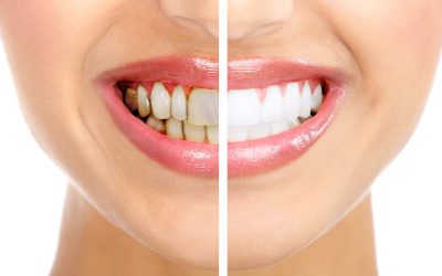 Achieve a Brighter Smile by Choosing a Cosmetic Dentist Deforest WI Recommends